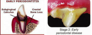 Grade 2 Dental Disease