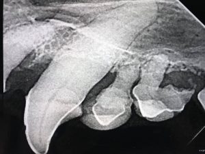 Dental X-Ray